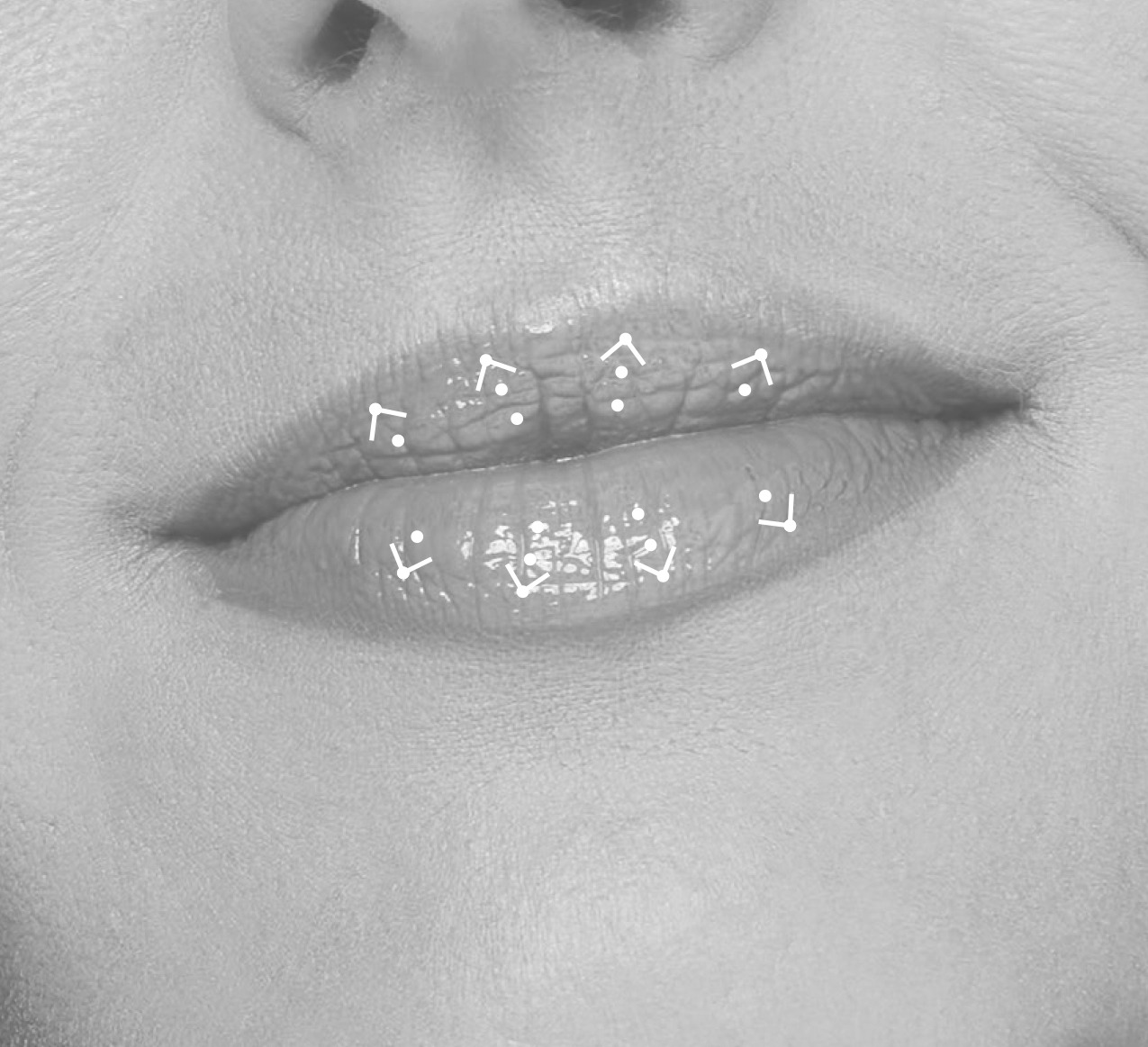 lier_lippenplastik·gs