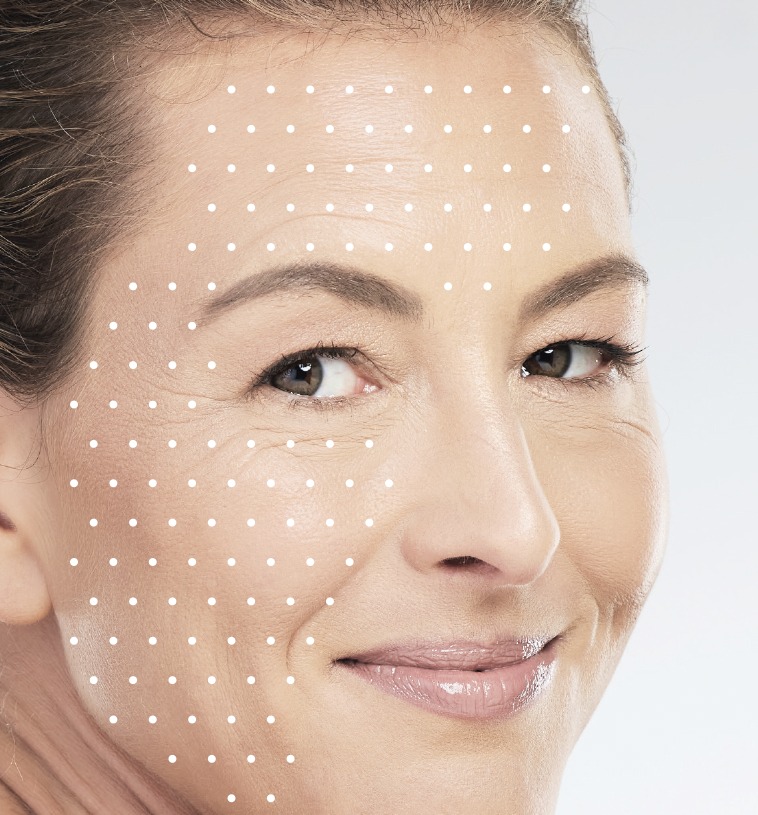 lier_microneedling·3c